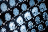 МРТ головного мозга: показания, противопоказания, особенности и стоимость