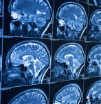 МРТ головного мозга: всё, что нужно знать пациенту