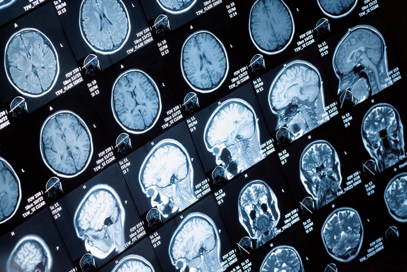 МРТ головного мозга: как делать, для чего нужно и сколько стоит в Москве?. Картинка 1