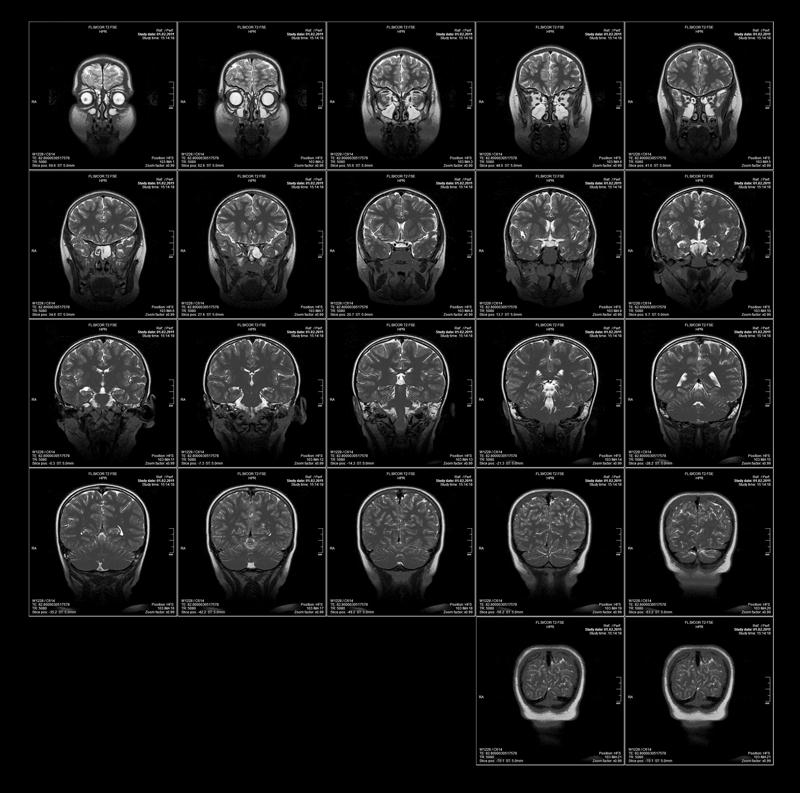 Как делают мрт головы и сосудов головного мозга взрослым фото до и после