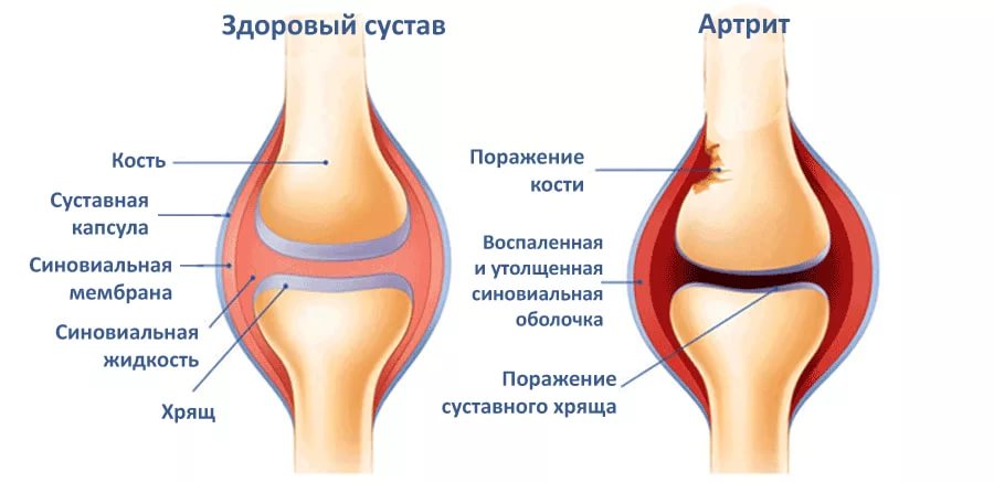 Артрит суставов – причины возникновения и методы лечения. Картинка 2