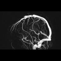 МРТ сосудов мозга