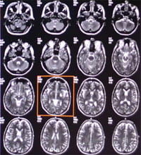 МРТ-исследование сосудов головного мозга