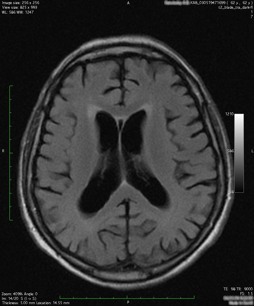 Снимок мозга. Снимок 43