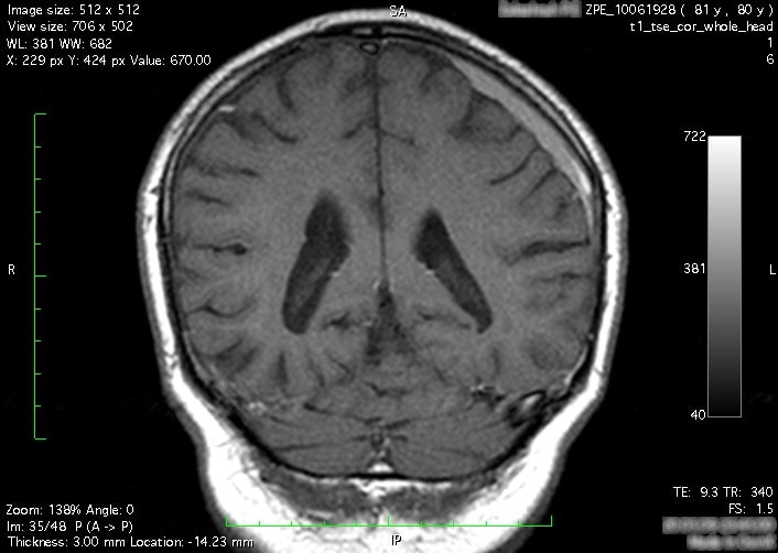 Снимок мозга. Снимок 6